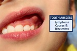 Tooth Abscess | Dental Abscess Symptoms, Causes & Treatment
