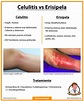 Celulitis vs Erisipela: Diagnóstico diferencial - Chuletas Médicas