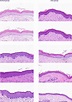 Representative pictures showing scar tissue at 1, 2, 3, and 5 months ...