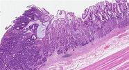 Adenocarcinoma of the stomach - MyPathologyReport.ca