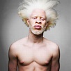 15+ Albino People Who’ll Mesmerize You With Their Otherworldly Beauty ...