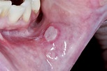 Mouth ulcers - NHS