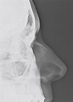 Fractura de tabique nasal | Tabique, Imagen radiologica