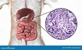 Stomach Adenocarcinoma, Gastric Cancer, Illustration and Light ...