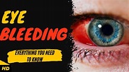 Eye Bleeding: Everything You Need To Know - YouTube