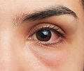 Pink Eye: Symtoms, Diagnosis, Treatment, and Prevention