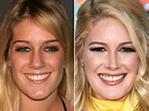 Heidi Montag Before and After: From 2006 to 2022 - The Skincare Edit