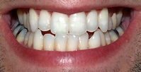 Human teeth - wikidoc