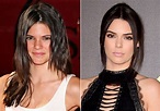 Kendall Jenner Before and After Plastic Surgery