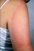 Lyme Disease - Dermatology Advisor