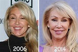 Linda Thompson Plastic Surgery Before & After Linda Thompson, Jawline ...