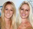 Heidi Montag Nose Job Plastic Surgery Before and After | Celebie