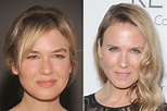 Renee Zellweger Plastic Surgery Before And After Facelift