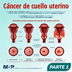 Cáncer de cuello uterino - Infografía