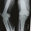 Distal Femoral Fractures: Complications and How to Avoid them? – Trauma ...