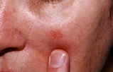 Actinic Keratosis - Causes, Symptoms & Actinic Keratosis Treatment