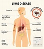 Lyme Disease In Children: Causes, Symptoms And Treatment