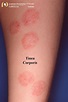 Tinea Corporis: Ringworm, Tinea Circinata... - Academic Dermatology of ...