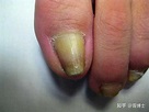 请问初期灰指甲应该如何治疗？ - 知乎