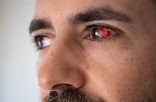 What Causes Blood Vessels To Break on the Eye? | Abbotsford