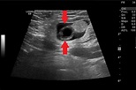 Utilidad del ultrasonido en el diagnóstico de hernia inguinal en el ...
