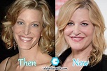 Anna Gunn Plastic Surgery, Before and After Pictures - Celebritieswith.com