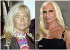 Donatella Versace Plastic Surgery before and after photo showing lip ...