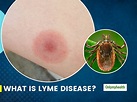 What Is Lyme Disease? Here Are Its Causes, Symptoms, Prevention And ...