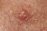 Pictures of Melanoma and Other Skin Cancers
