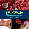 Leucemia: Causas, Síntomas Y Tratamiento - La Guía de las Vitaminas