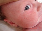 Prickly Heat Rash Baby Treatment : Prickly Heat Rash Pictures, Symptoms ...