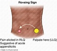 Rovsing Sign Illustration by Tejeswini Padma | Medical Illustration ...