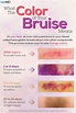 Anatomy of a bruise – Artofit