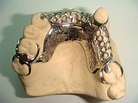 Bases Metalicas ~ Laboratorio Dental Alvadent