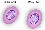Atypical mitosis | MyPathologyReport.ca