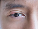 小心「3個壞習慣」害你長針眼！ 眼科醫警告：拉眼尾、戳破膿包恐愈慘