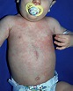 Roseola Rash - Pictures (Photos, Images), Causes, Treatment