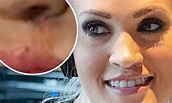 Carrie Underwood reveals scar on lip as she worries disfigurement would ...