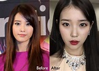 Iu Plastic Surgery Before And After Photos Plastic Su - vrogue.co