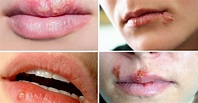 Cómo tratar el herpes labial: una infección común pero incómoda