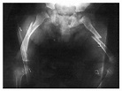 Bilateral Femur Fractures | NEJM