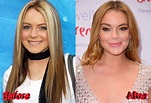 Lindsay Lohan Plastic Surgery : Is She Done With It?