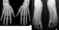 Radiological Peripheral Involvement in a Cohort of Patients with ...