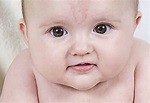 Birthmarks in Babies - Types, Causes & Treatment