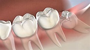 What To Know About Wisdom Tooth Extraction - hanoverorient