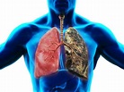 Copd Lunge : COPD - veränderte Lunge, verändertes Mikrobiom ... / Wenn ...