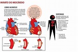Enfarte Do Miocárdio Tratamento : Cuidados após um enfarte agudo do ...