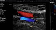 Ultrasonido Doppler Arterial Venoso | Dr. Emmanuel Acuña