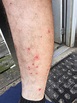 Medical: Scabies Reported Along Southern Virginia AT - The Trek
