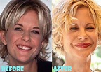 Meg Ryan Plastic Surgery Before After Photos - Lovely Surgery ...